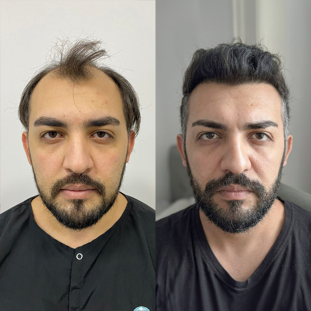 Hair Transplant Result