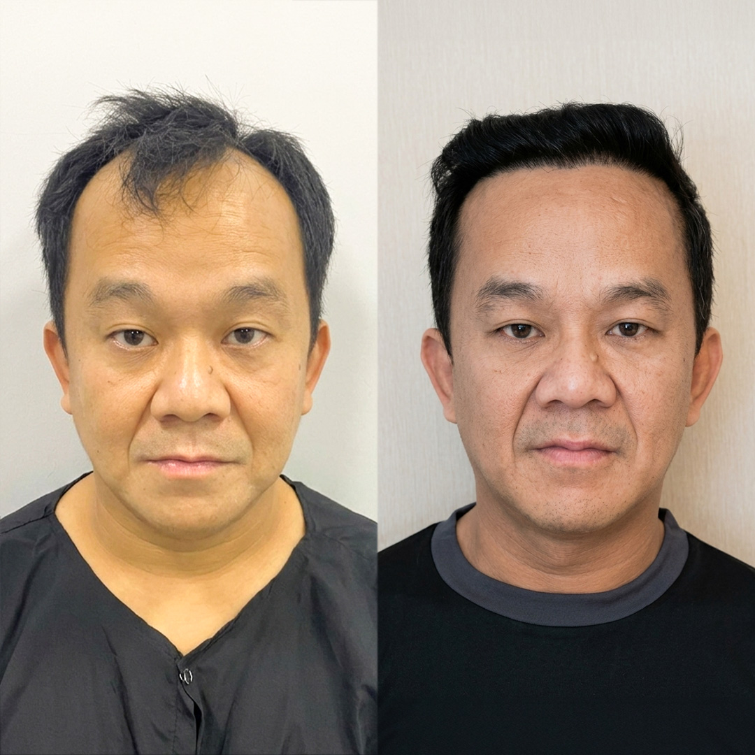 Hair Transplant Result
