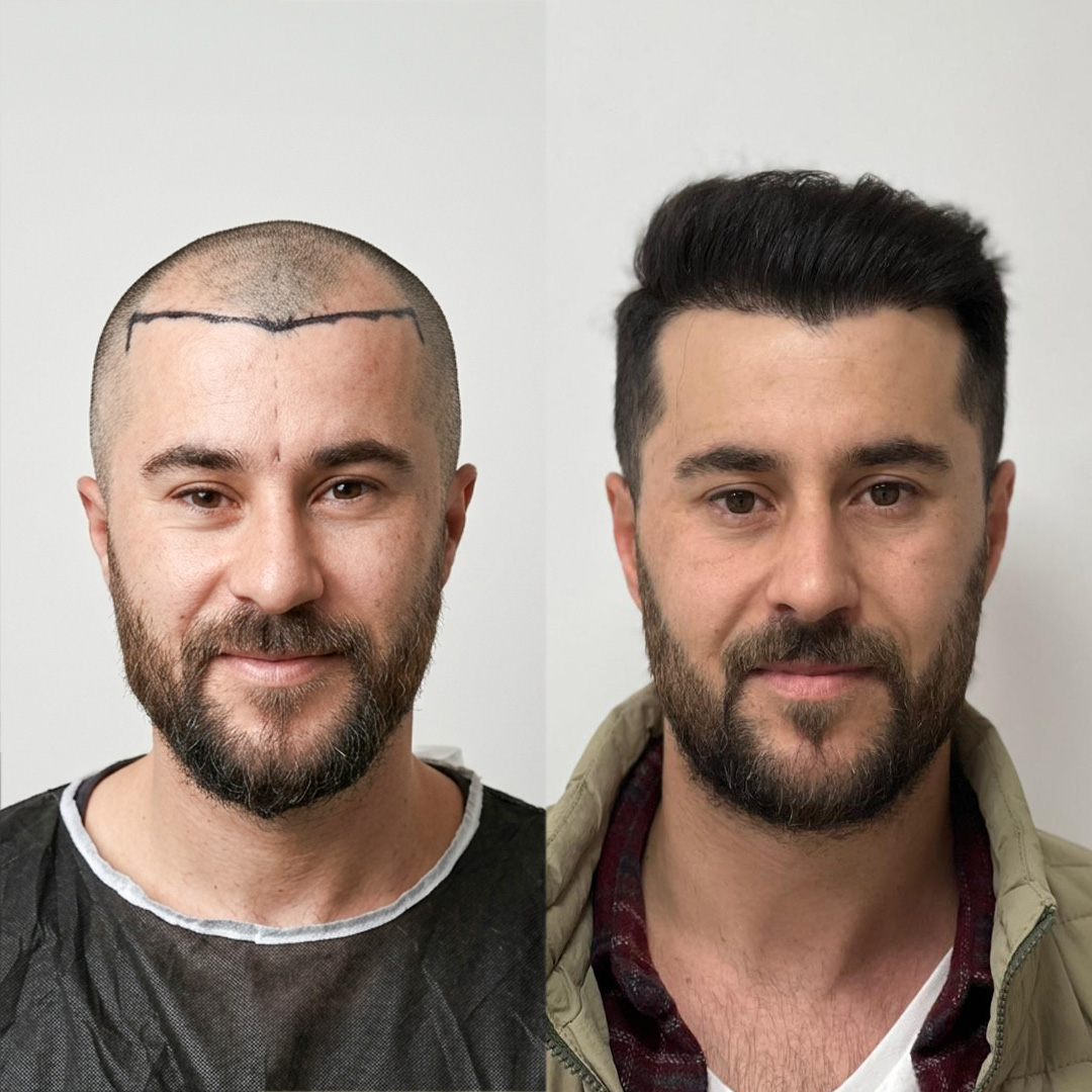 Hair Transplant Result