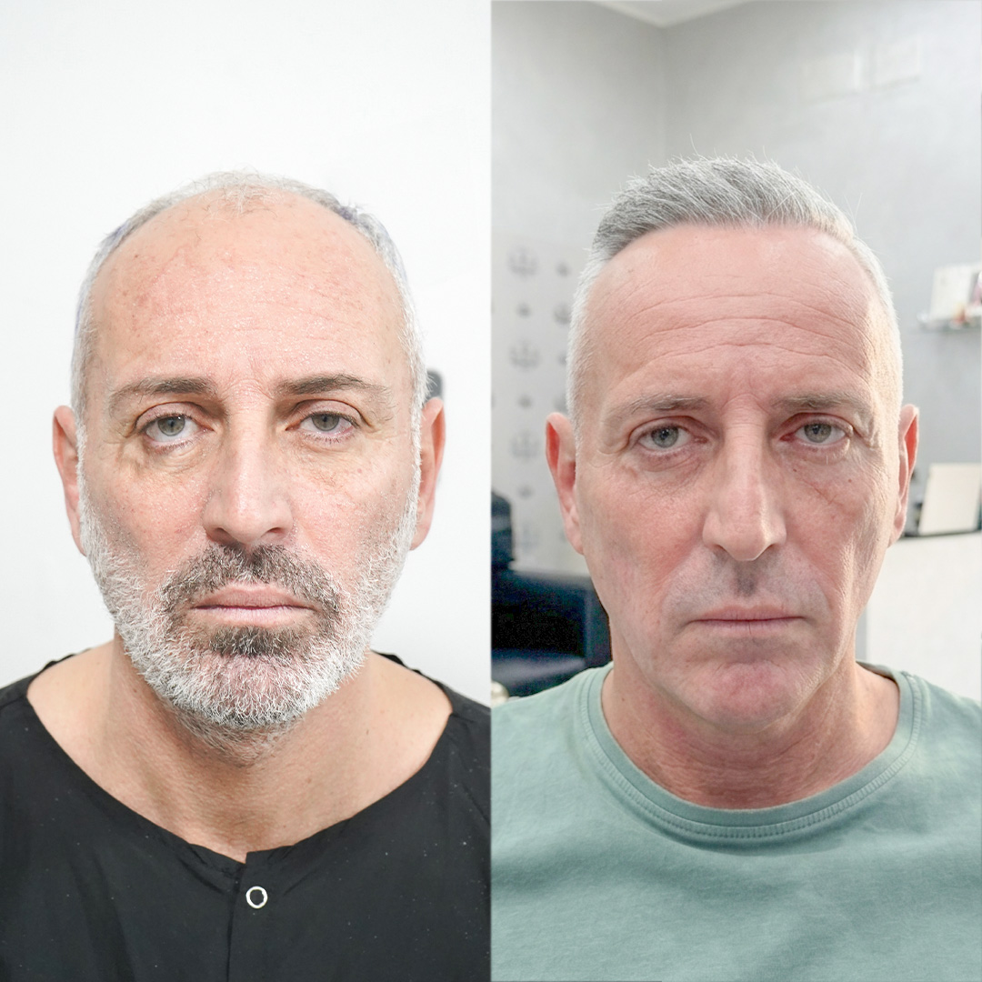 Hair Transplant Result