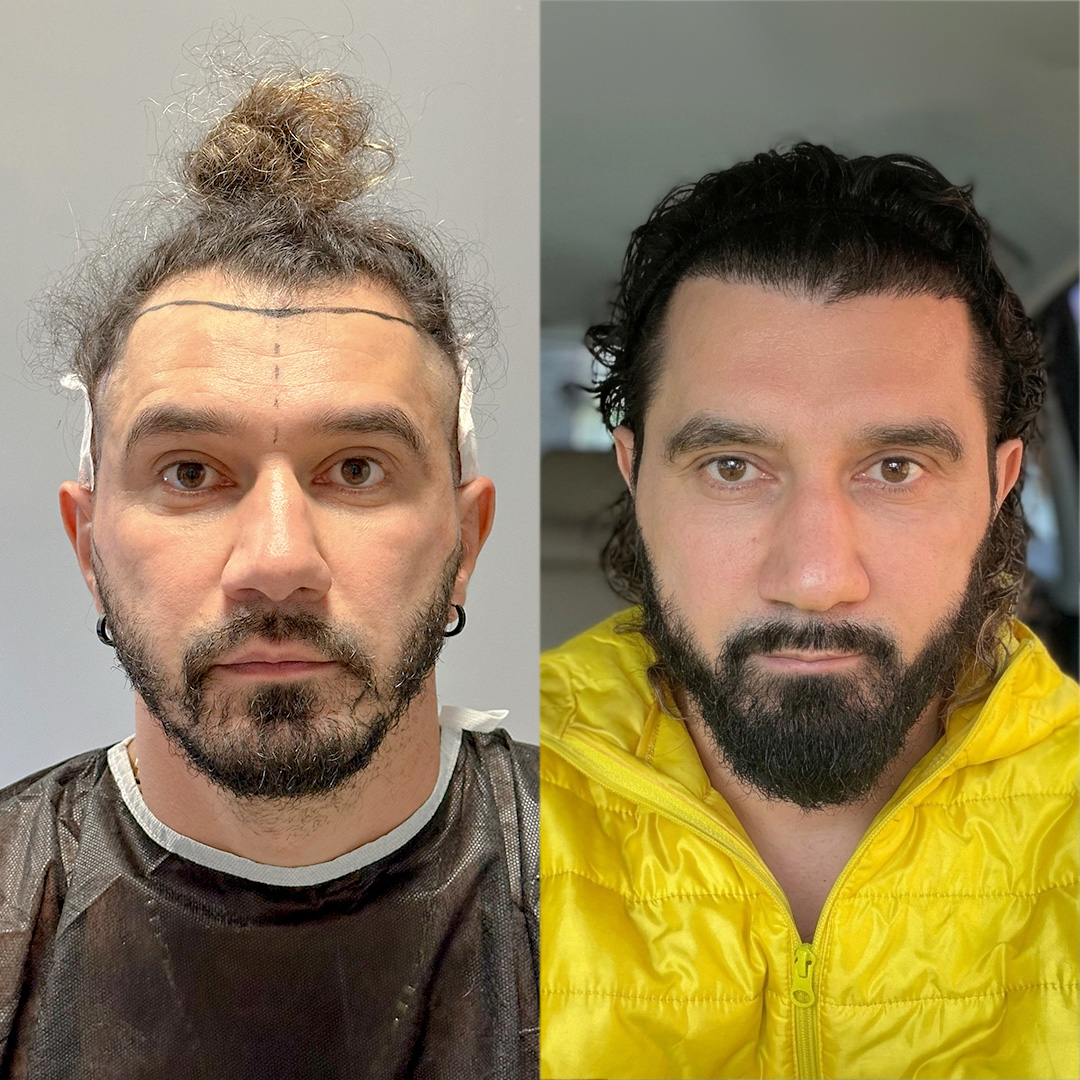 Hair Transplant Result