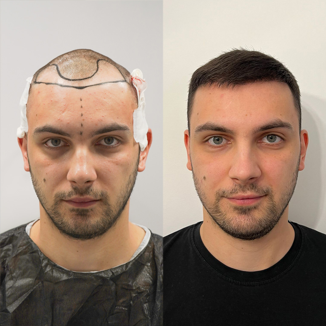 Hair Transplant Result