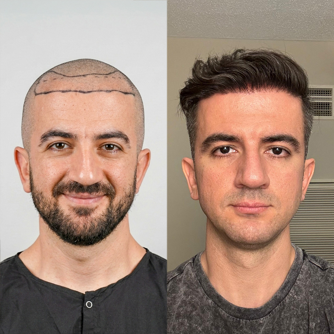 Hair Transplant Result